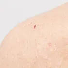 アトピー
